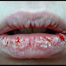 DRY OR CRACKED LIPS, CAUSES, POSSIBLE HOME REMEDIES TO PREVENT IT