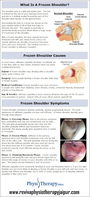 Physiotherapist in Jhotwara: Exercises for a Frozen Shoulder