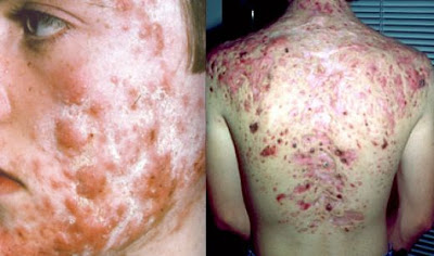 Cystic Acne Pictures