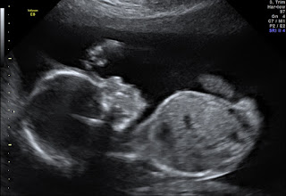 Ultrasound picture of Rumer