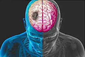 obat mengobati lumpuh karena stroke ringan, apa obat herbal stroke sebelah kanan yang manjur?, Bagaimana Mengobati Sakit Stroke Ringan?