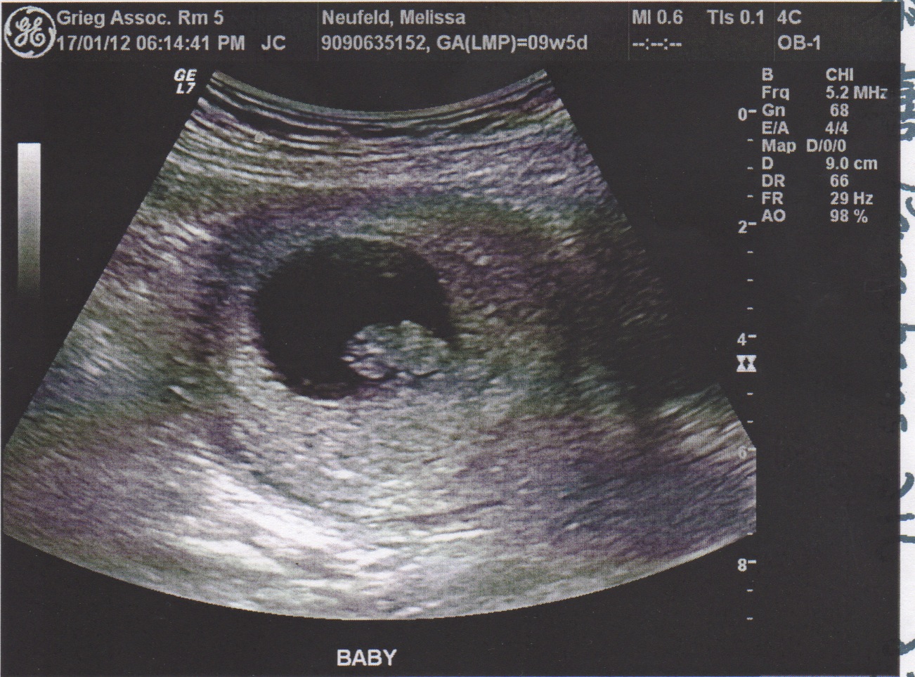 Когда на узи видно беременность на ранних. УЗИ 10 недель беременности. Плодное яйцо на УЗИ 10 недель беременности. Снимок УЗИ эмбриона на 8 неделе беременности.