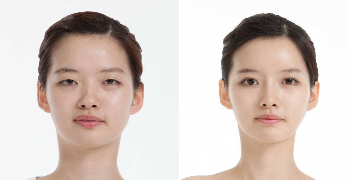 Plastic Surgery in Korea Byebye Thick and Dark Undereye through