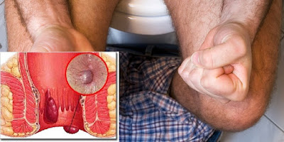 Foto Nama Obat Wasir Yang Sering Kambuh Lagi Yang Paling Laris