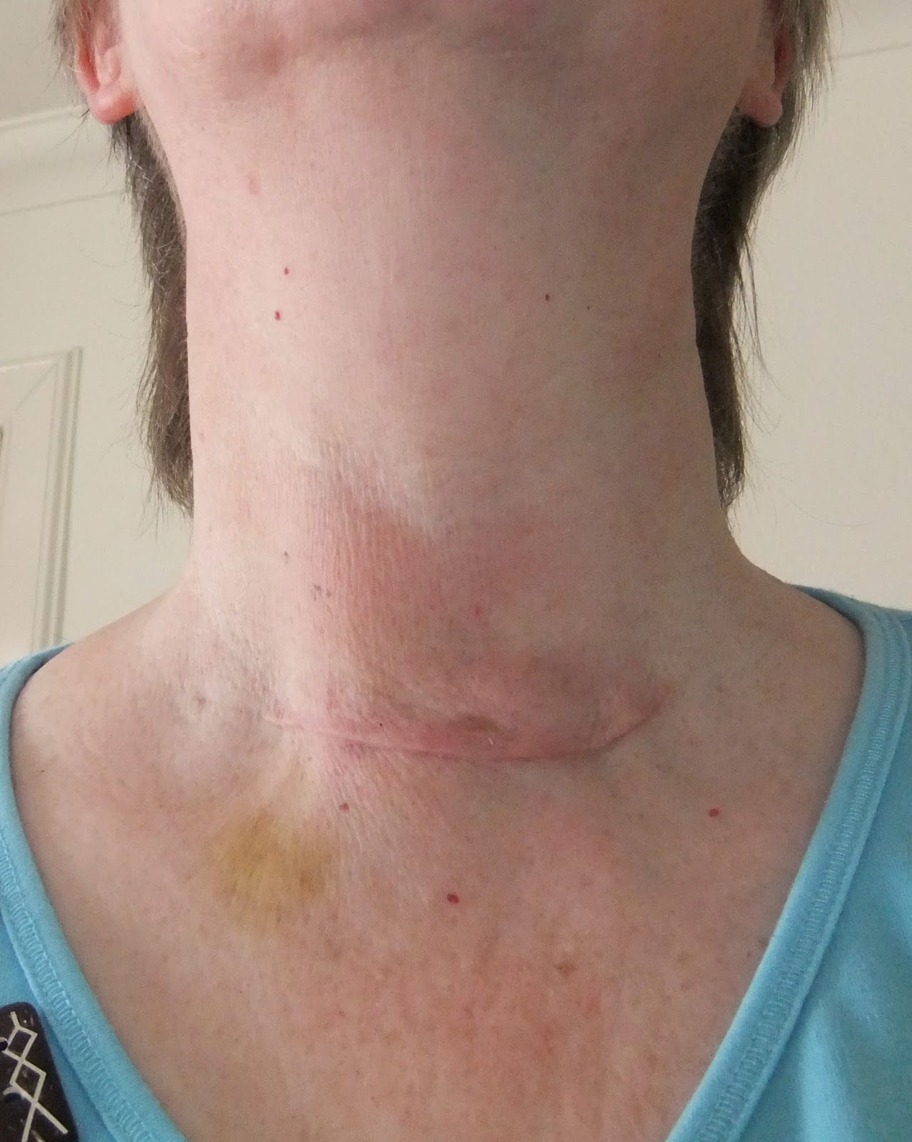 Partial Thyroidectomy Before and After Photos Partial Thyroidectomy