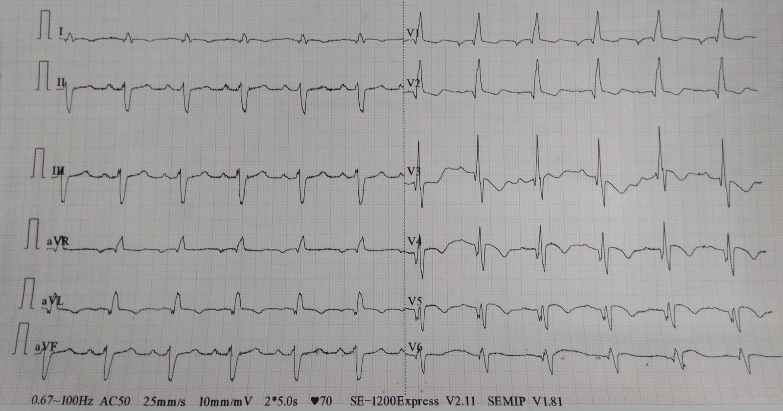 Cardiology window Trifascicular block