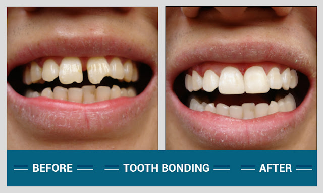 bonding teeth