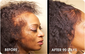 Natural Hair Restoration Products Natural Hair Restoration Products