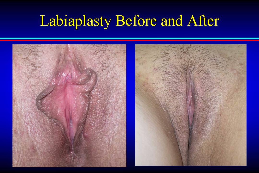 Virgin tightening surgery before and after pics 🔥 Labiaplast
