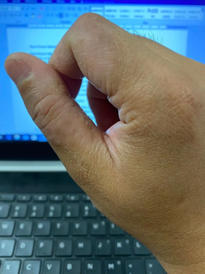 Contact dermatitis on fingers