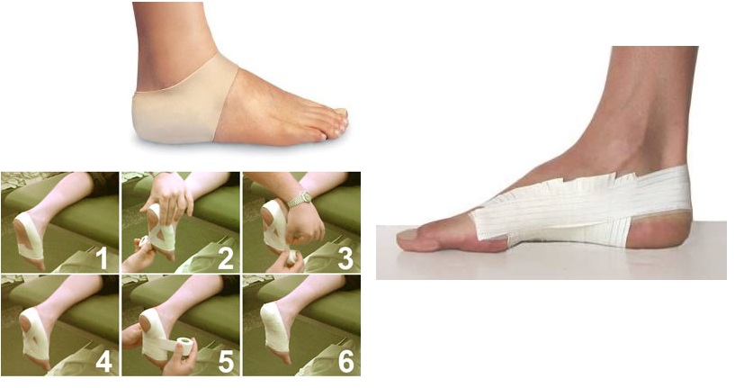 How to get rid of the spur: traditional and folk methods of treatment How to get rid of the spur: traditional and folk methods of treatment