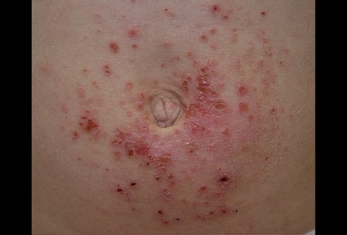 Contact dermatitis - Mayo Clinic