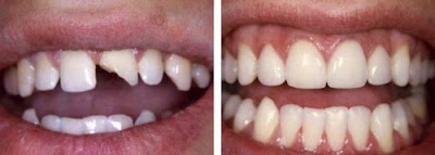 Trám răng không gây hại cho men răng