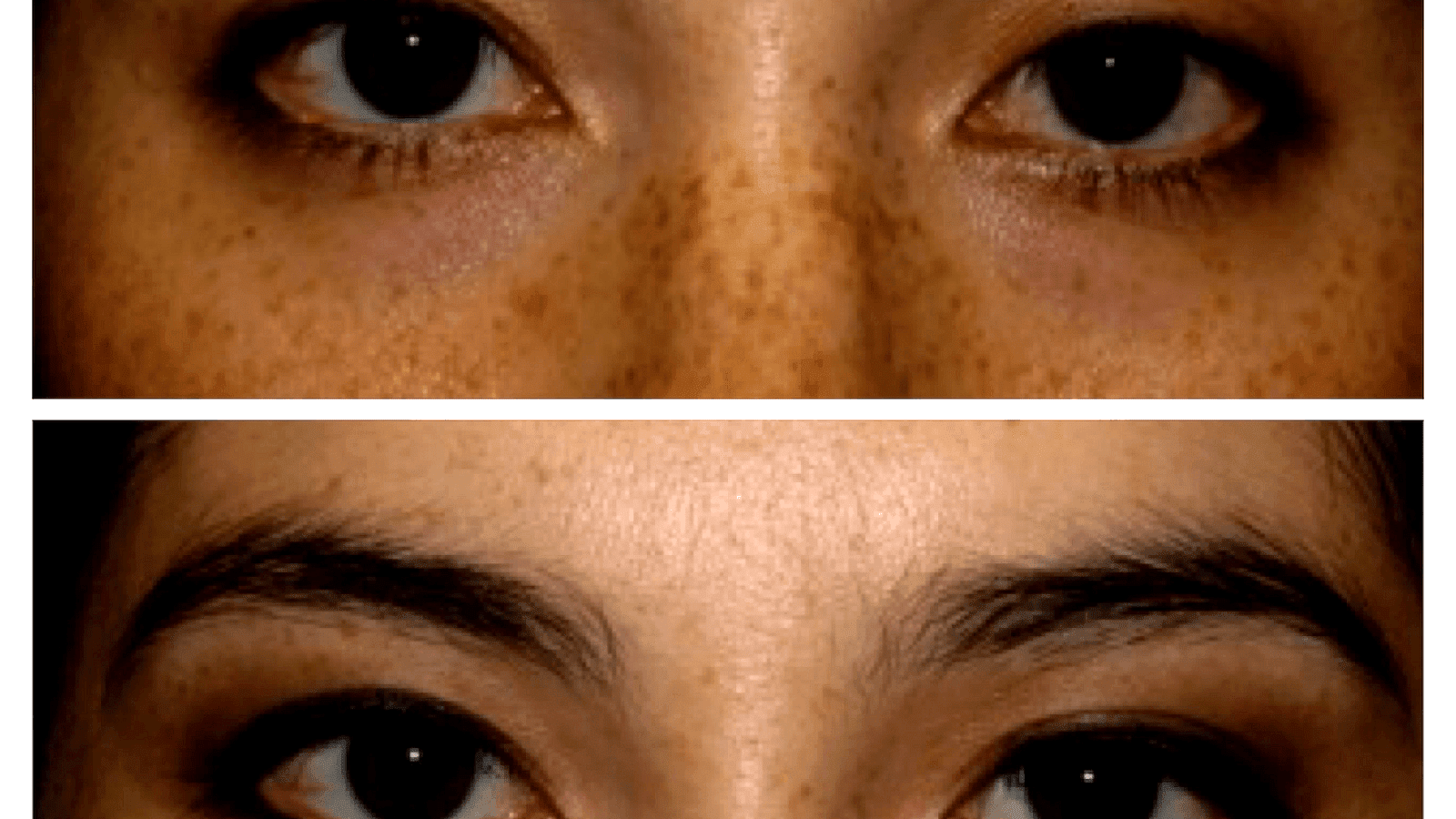 Side Effects Of Restylane Effect Choices