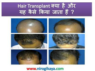 hair-transplant-information-procedure-cost-in-hindi