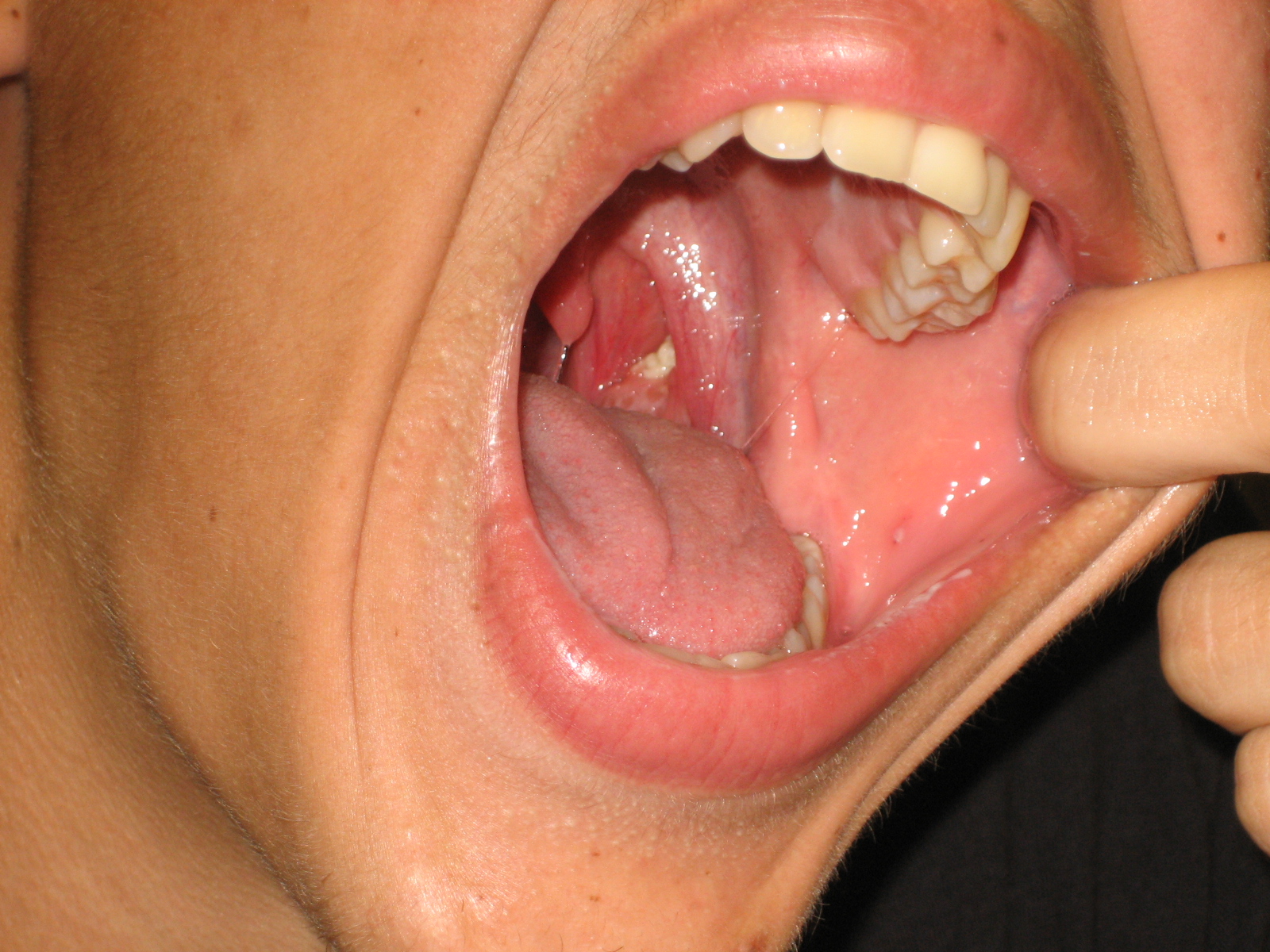 mouth cancer images #11