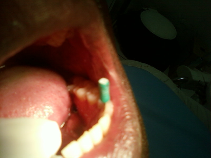 rukoma dental answers: Difference between food debris, dental plaque ...