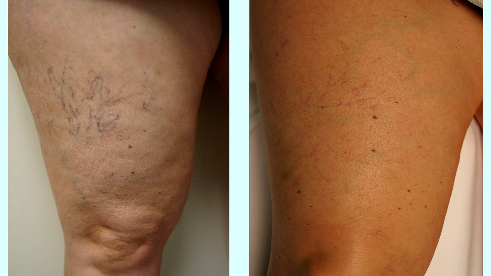 Cost For Spider Vein Treatment Treat Choices