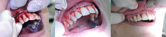 <Img src ="Cirugía-colgajo-periodontal-con-osteointegrador.jpg" width = "893" height "201" border = "0" alt = "Cirugía a colgajo periodontal">