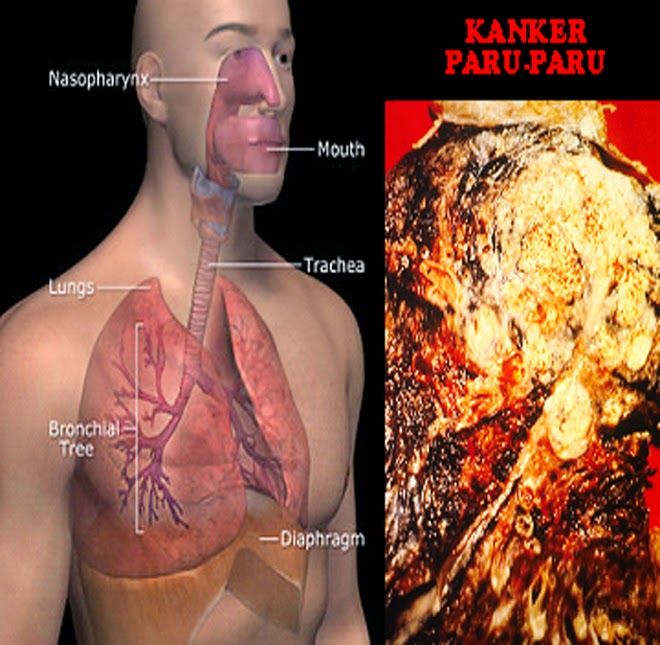 pengobatan tumor Paru paru alternatif, obat kanker paru, pengobatan kanker paru