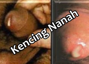 Daftar Nama Obat Paling Ampuh untuk Menyembuhkan Kencing Nanah - Daftar Nama Obat Paling Ampuh untuk Menyembuhkan Kencing Nanah -