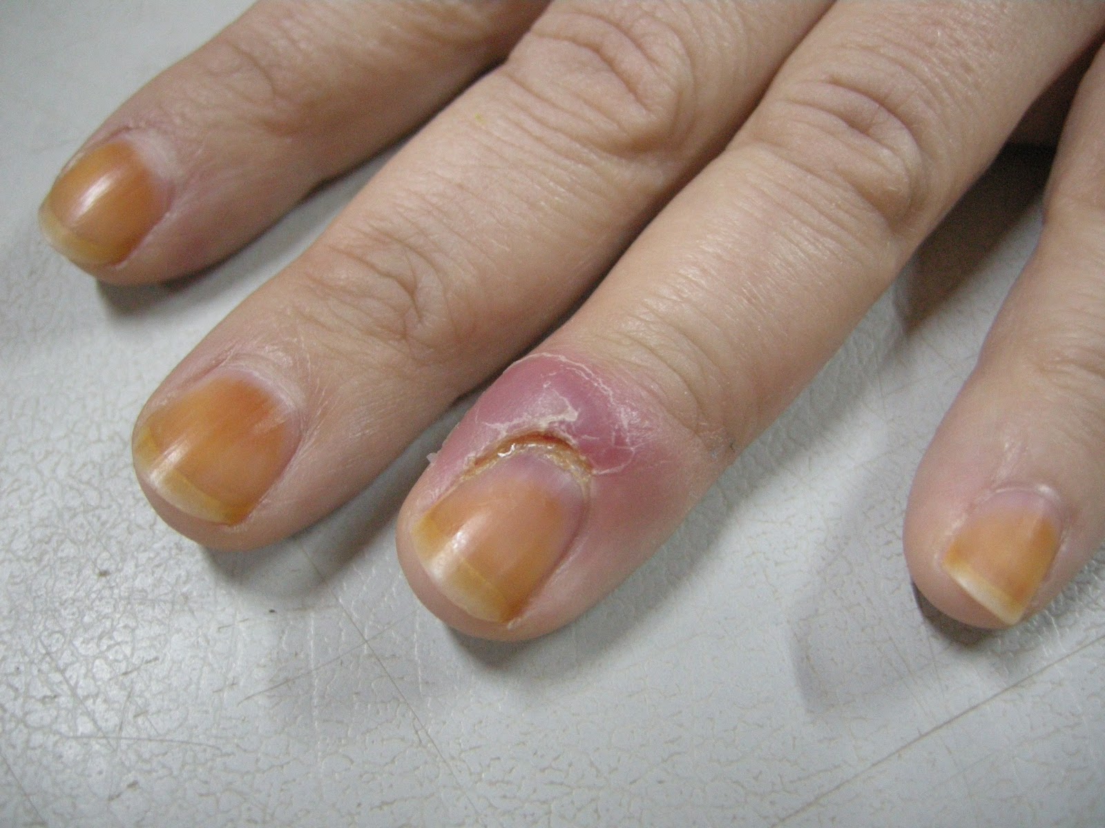 smilejustcoz: Finger infection