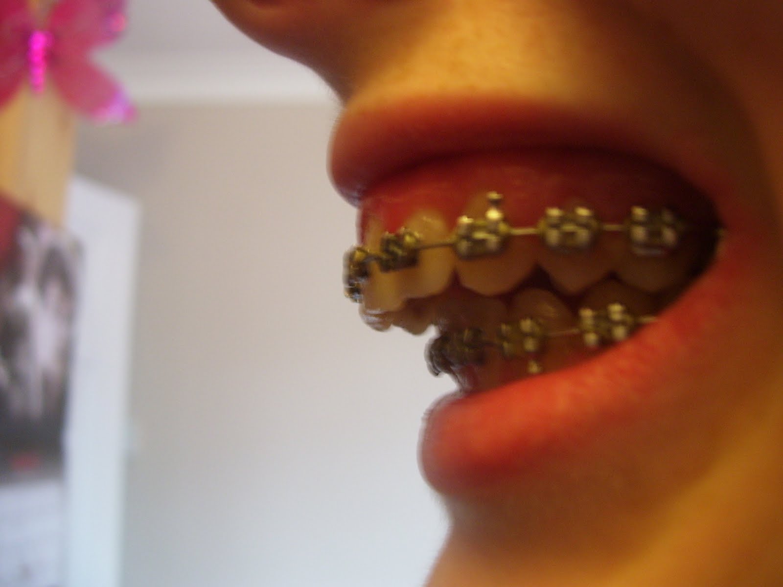 My Jaw Surgery Story 4 months of braces