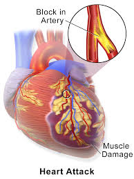 13 Ways to PREVENT HEART ATTACK Read it now and SAVE YOUR LIFE 13 Ways to PREVENT HEART ATTACK Read it now and SAVE YOUR LIFE
