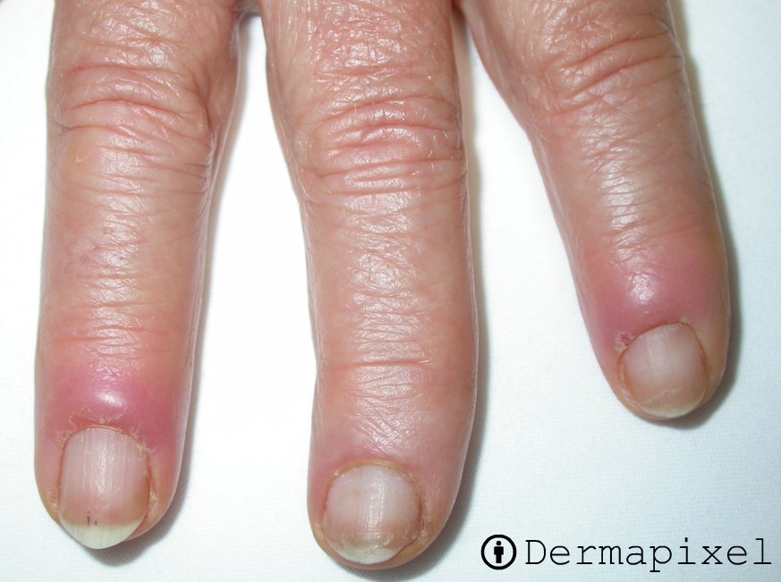 Dermapixel: Me duelen las uñas