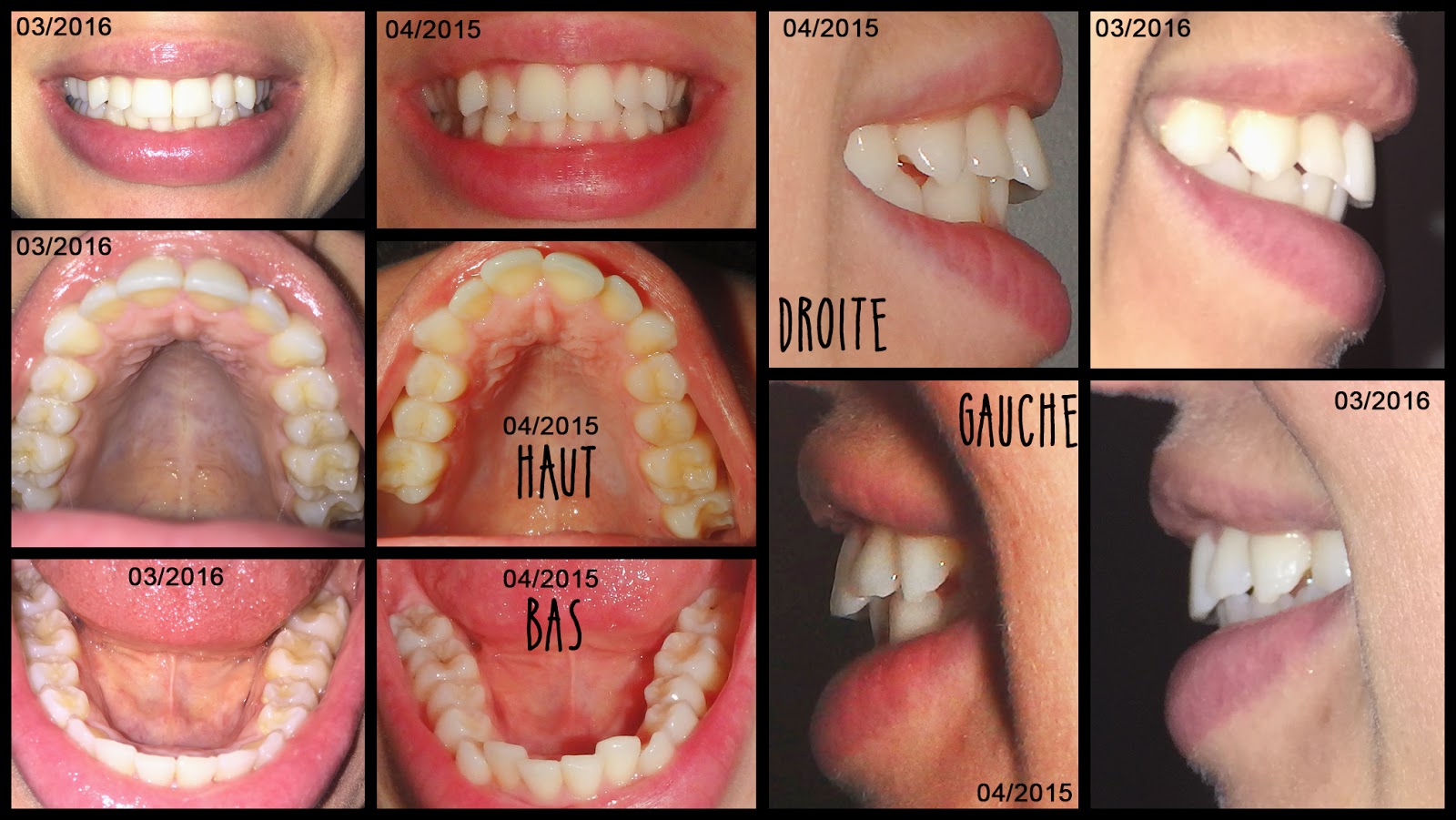 Invisalign Avis Blanchiment Des Dents Naturel