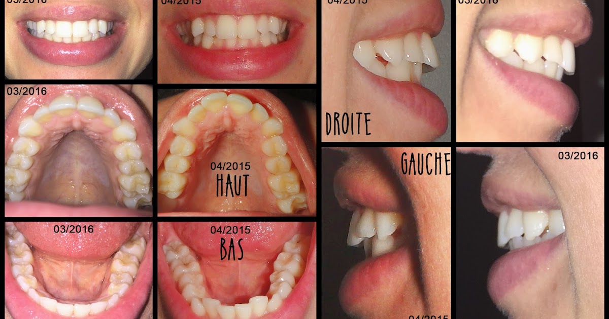 Mon avis sur le traitement Invisalign Quelques mois plus tard...