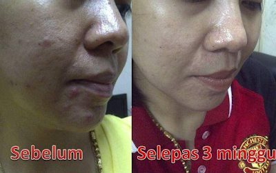 Testimoni Nour Ain Skincare