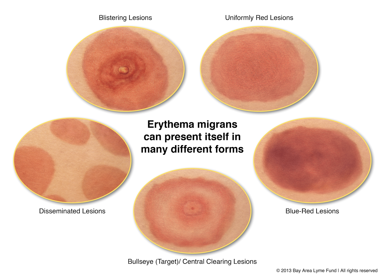 Gonorrhea Clinical Presentation: History, Physical Examination