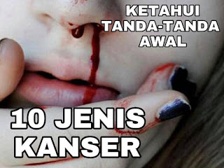 10 JENIS PENYAKIT KANSER PALING UTAMA KANSER