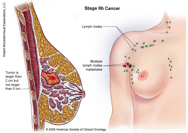 cancer breast 3rd stage