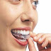 Ortoface na Cidade de Goiás - Clareamento Dental