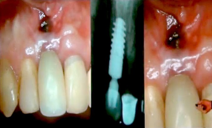 IMPLANTODONTIA: Reconstrução Óssea 3D para Implantes Dentários (Video 2)