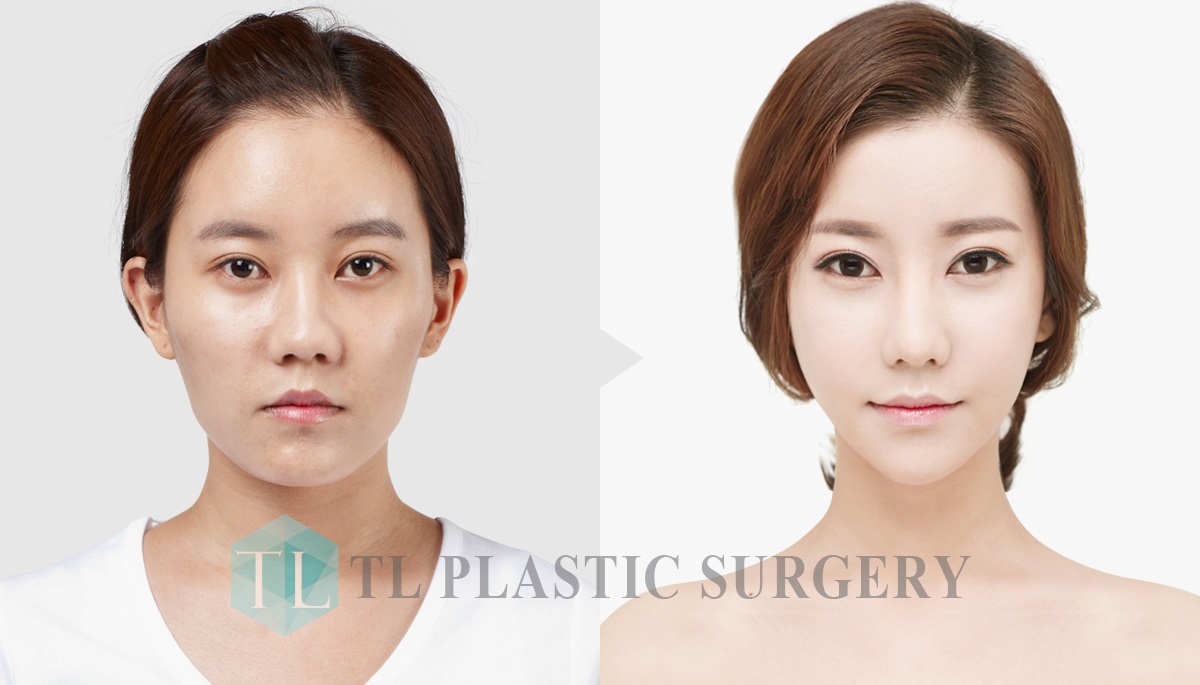 TL PLASTIC SURGERY CLINIC KOREA Before & After