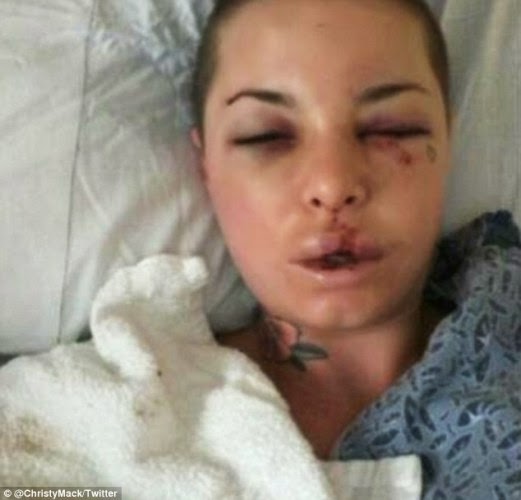Porn Star Injuries - Pics: porn star reveals injuries she suffered after horrific ...