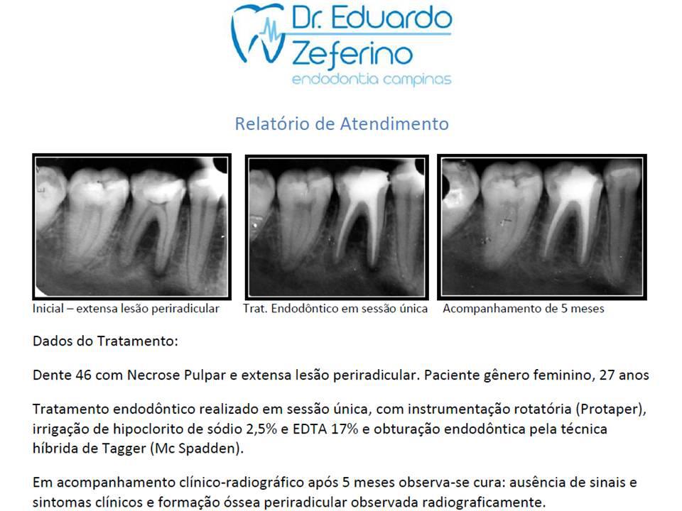 EQUIPE DE ENDODONTIA DE CAMPINAS Caso Clínico de Proservação do Tratamento Endodontico Dente46 EQUIPE DE ENDODONTIA DE CAMPINAS Caso Clínico de Proservação do Tratamento Endodontico Dente46