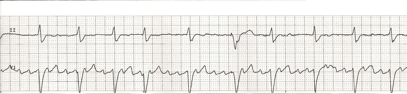 EKG Rhythm Strip Quiz 42