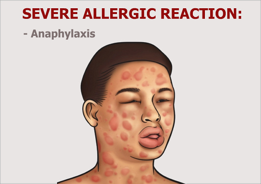 Severe Allergic Reaction, Anaphylaxis