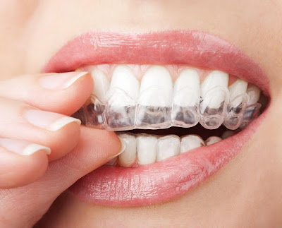 Hiệu quả của niềng răng trong suốt là gì?