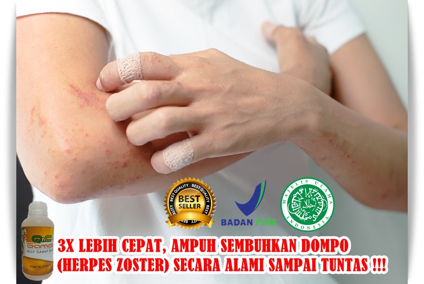 Cara Menyembuhkan Penyakit Dompo Secara Alami Sampai Tuntas, Terbukti