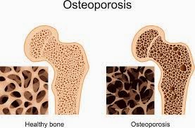 Obat Alami Osteoporosis
