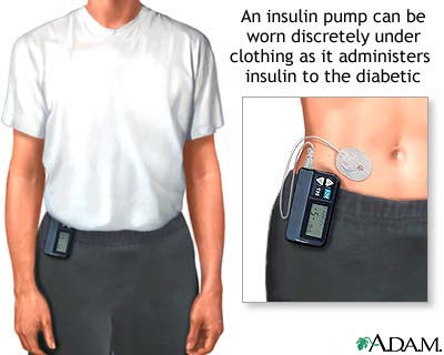 Insulin Pump System (Kelebihan, Kelemahan dan Cara Kerja ...