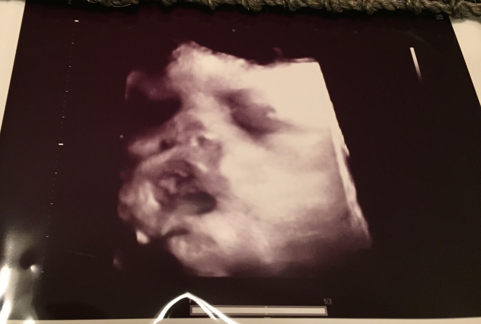 Fearfully and Wonderfully; The Story of Aubrey