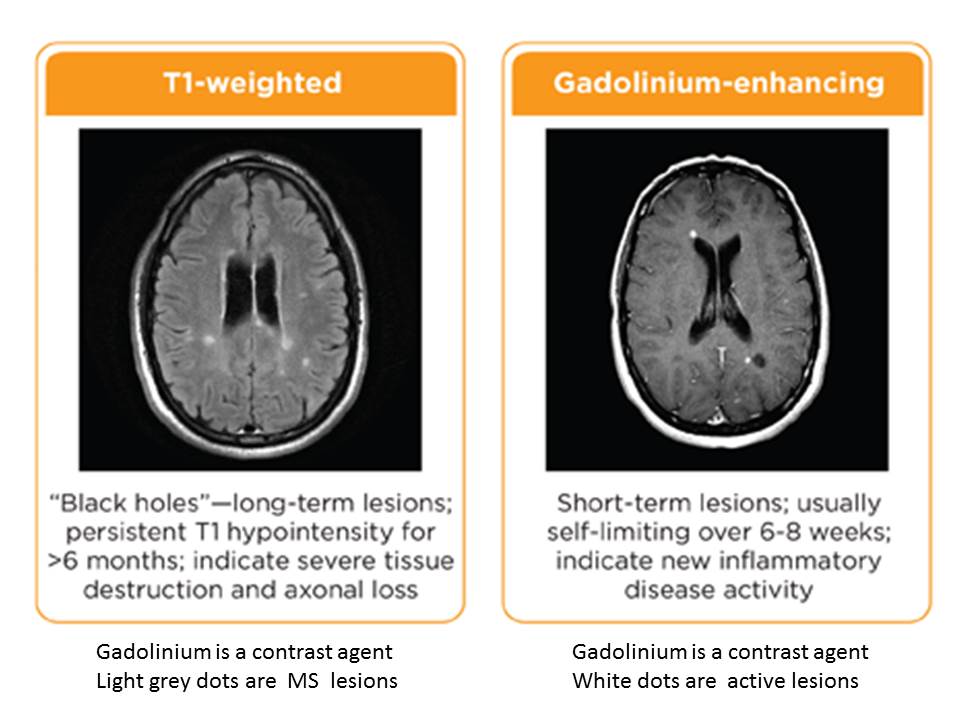 education-whats-an-mri-multiple-sclerosis-research-blog