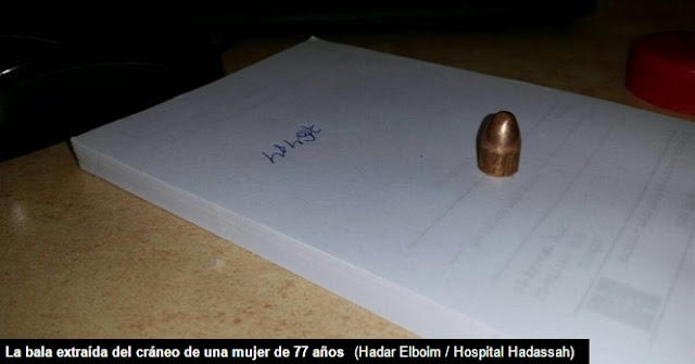La bala extraída del cráneo de una mujer de 77 años - Hadar Elboim - Hospital Hadassah La bala extraída del cráneo de una mujer de 77 años - Hadar Elboim - Hospital Hadassah