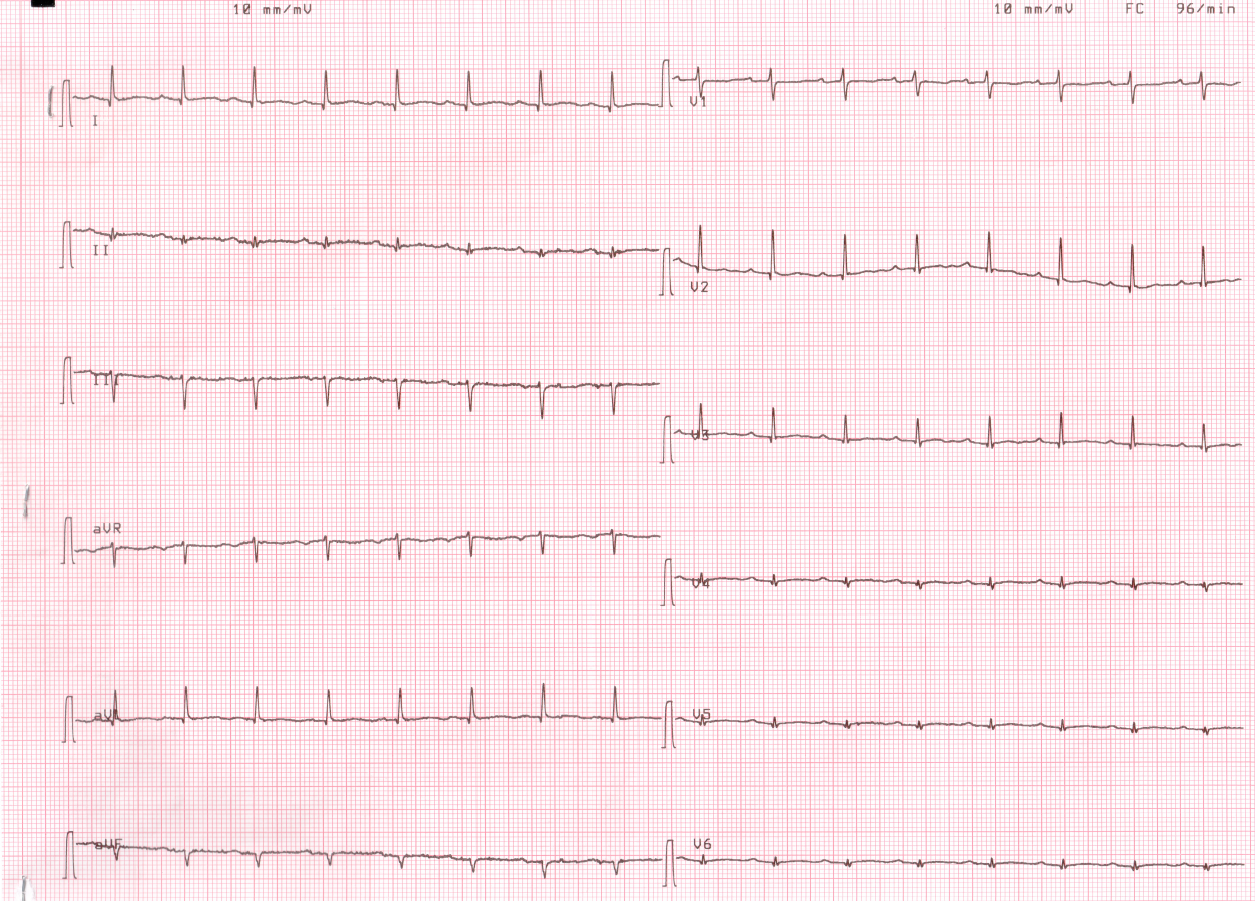 Dr. Smith's ECG Blog A Pathognomonic ECG